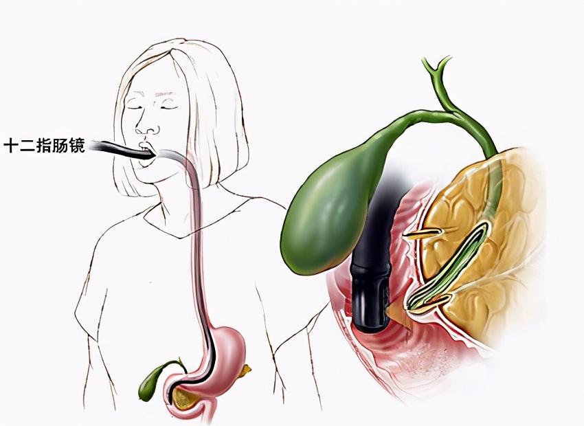 吃不焯水的菠菜会得肾结石吗_权限解释落实