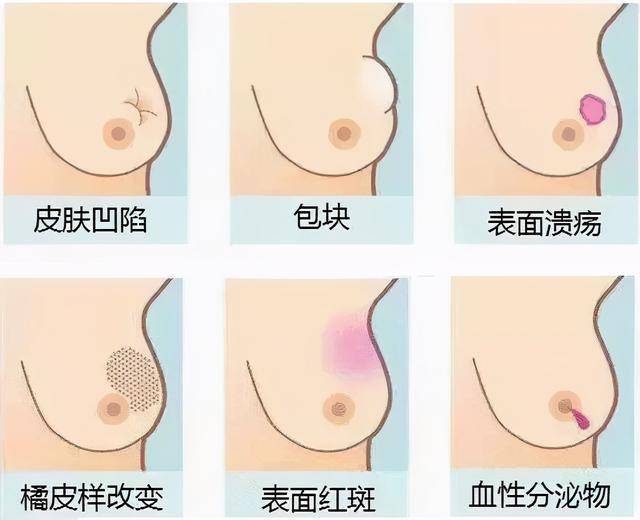 乳腺癌早期是什么状态_解释落实